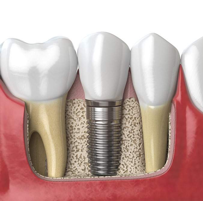  Was sind Zahnimplantate?